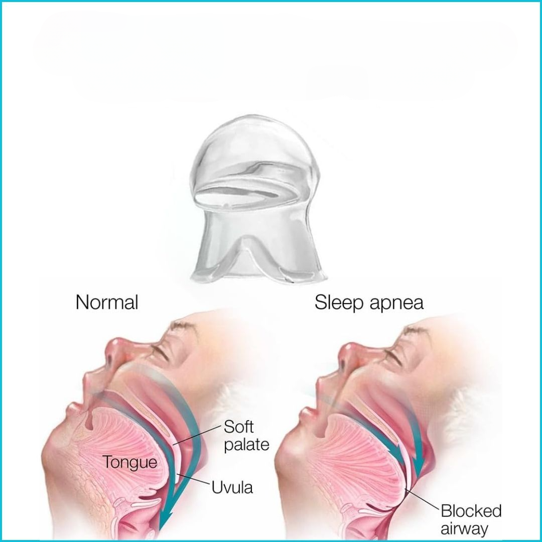 HarmonieLab™ - Night Comfort Mouthpiece